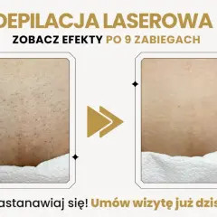 Porównanie skóry przed i po depilacji laserowej: widoczne zmniejszenie owłosienia.