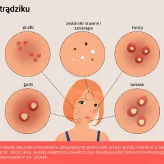 Ilustracja pokazuje różne rodzaje trądziku: grudki, krosty, guzki, torbiele, zaskórniki. Od czego wychodzą pryszcze? Od zaburzeń hormonalnych, genetyki, wirusów, grzybów, bakterii i nadmiernej produkcji sebum.