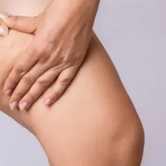 Dłoń uciska udo z widocznym cellulitem. Moja historia: jak pozbyłam sie cellulitu.
