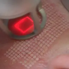 Zabieg laserem frakcyjnym: czy laser frakcyjny jest bezpieczny? Skóra po zabiegu z widocznymi mikrouszkodzeniami.