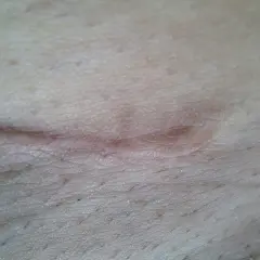Zbliżenie na gojący się strupek na skórze z widocznymi porami i włoskami.
