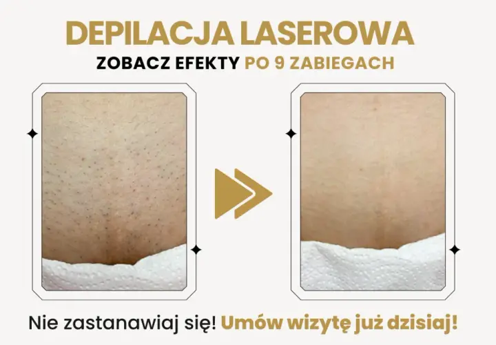 Porównanie skóry przed i po depilacji laserowej: widoczne zmniejszenie owłosienia.