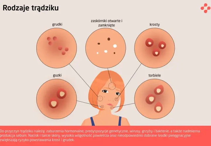 Ilustracja pokazuje różne rodzaje trądziku: grudki, krosty, guzki, torbiele, zaskórniki. Od czego wychodzą pryszcze? Od zaburzeń hormonalnych, genetyki, wirusów, grzybów, bakterii i nadmiernej produkcji sebum.