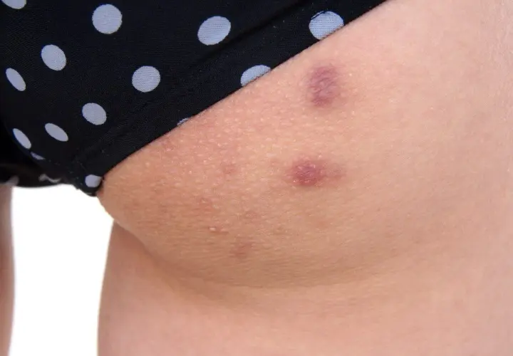 Skóra z kropkami i zaczerwienieniami, które mogą być oznaką tego, co na pryszcze na pupie.