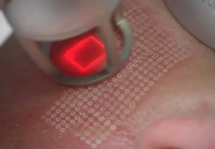 Zabieg laserem frakcyjnym: czy laser frakcyjny jest bezpieczny? Skóra po zabiegu z widocznymi mikrouszkodzeniami.