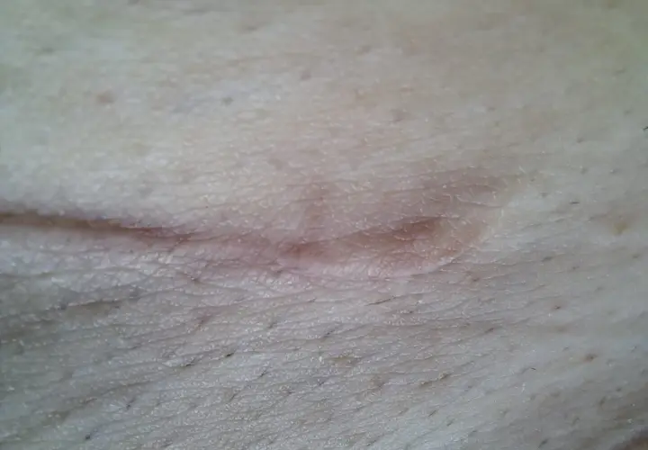 Zbliżenie na gojący się strupek na skórze z widocznymi porami i włoskami.