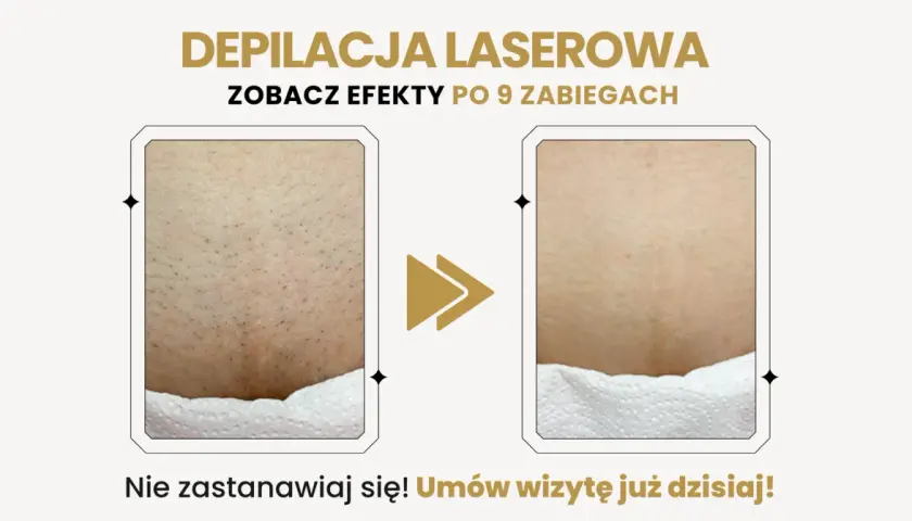 Porównanie skóry przed i po depilacji laserowej: widoczne zmniejszenie owłosienia.