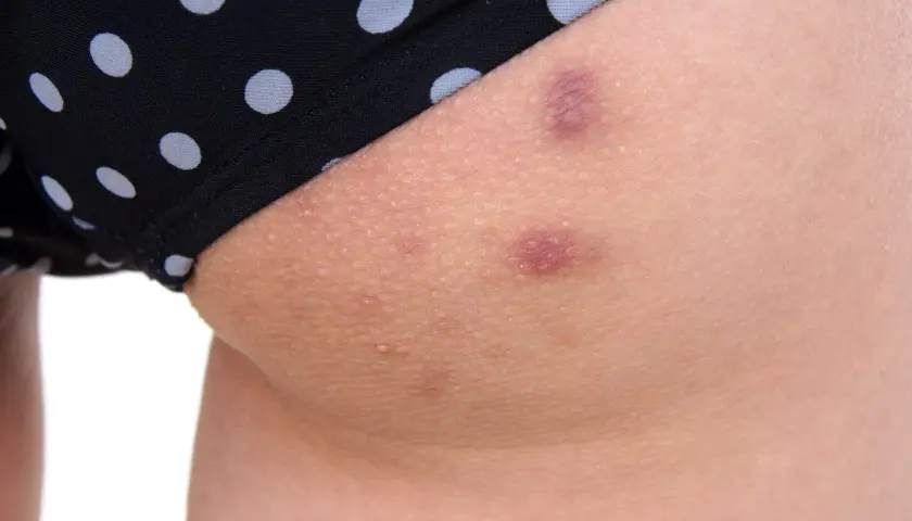 Skóra z kropkami i zaczerwienieniami, które mogą być oznaką tego, co na pryszcze na pupie.