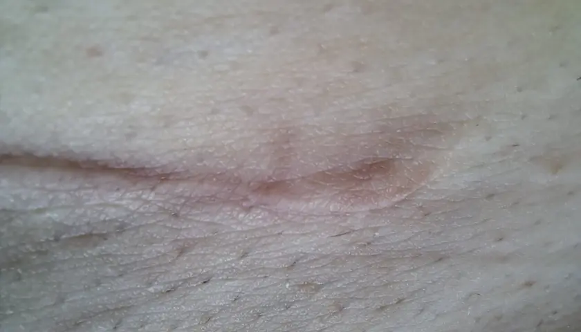Zbliżenie na gojący się strupek na skórze z widocznymi porami i włoskami.