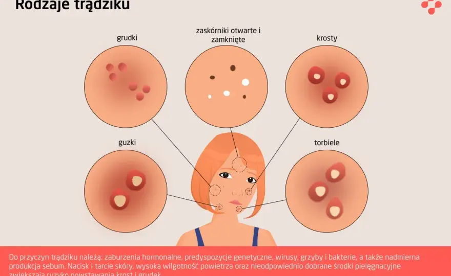 Od czego pryszcze? Przyczyny, rodzaje i skuteczne sposoby walki