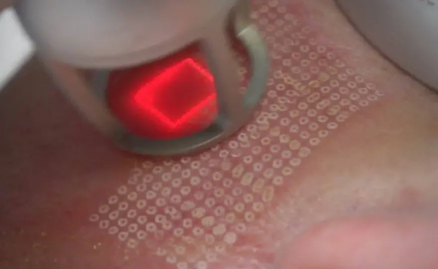 Laser frakcyjny: Czy jest bezpieczny? Poznaj fakty i ryzyka
