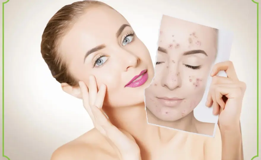 Co na pryszcze? Skuteczne sposoby i składniki aktywne
