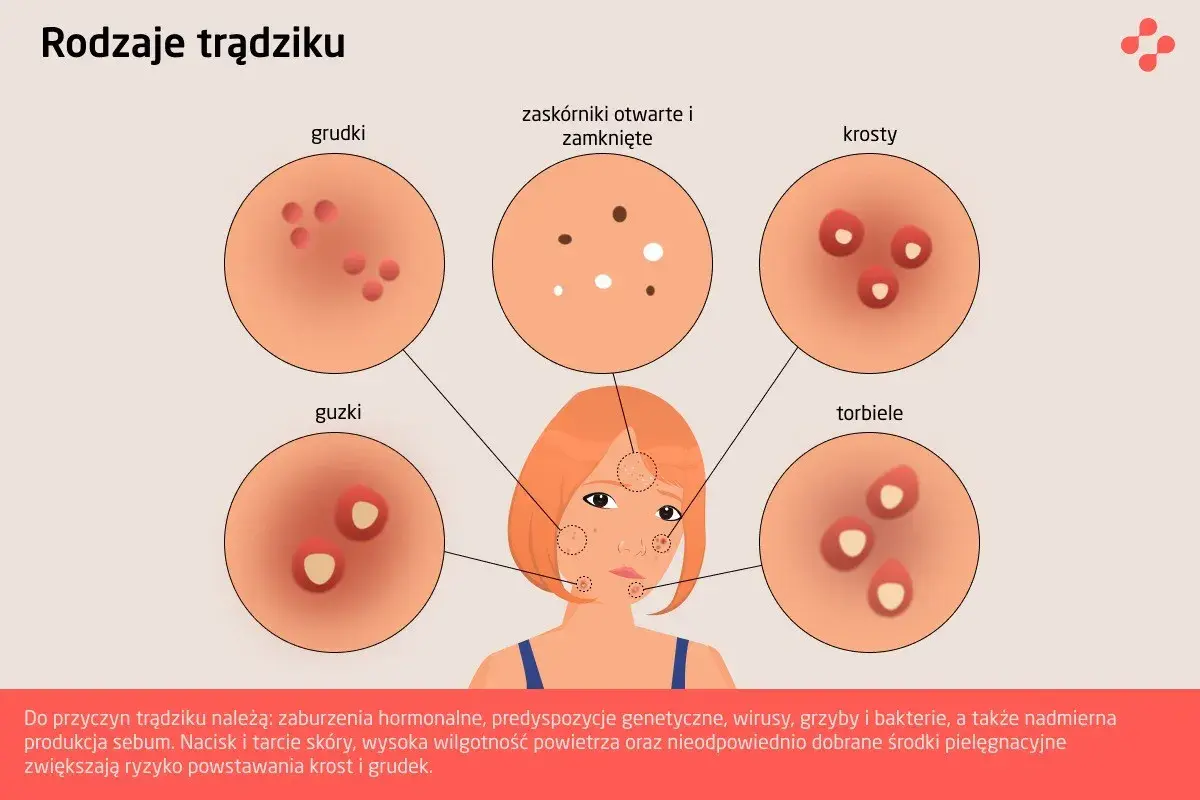 Ilustracja pokazuje różne rodzaje trądziku: grudki, krosty, guzki, torbiele, zaskórniki. Od czego wychodzą pryszcze? Od zaburzeń hormonalnych, genetyki, wirusów, grzybów, bakterii i nadmiernej produkcji sebum.