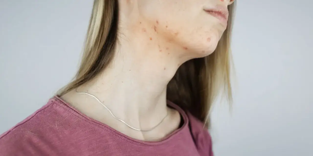 Pryszcze na szyi mogą oznaczać różne rzeczy, od zmian hormonalnych po reakcję alergiczną.