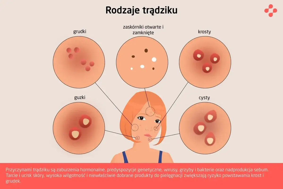 Ilustracja pokazuje r&oacute;żne rodzaje trądziku: grudki, zask&oacute;rniki, krosty, guzki i cysty. Od czego wychodzą pryszcze? Od zaburzeń hormonalnych, genetyki, wirus&oacute;w, grzyb&oacute;w, bakterii i nadprodukcji sebum.