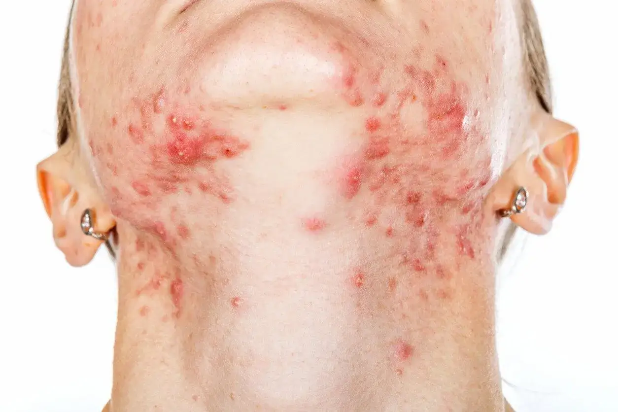 Widoczne liczne pryszcze na szyi i żuchwie. Mogą oznaczać problemy hormonalne lub reakcję alergiczną.