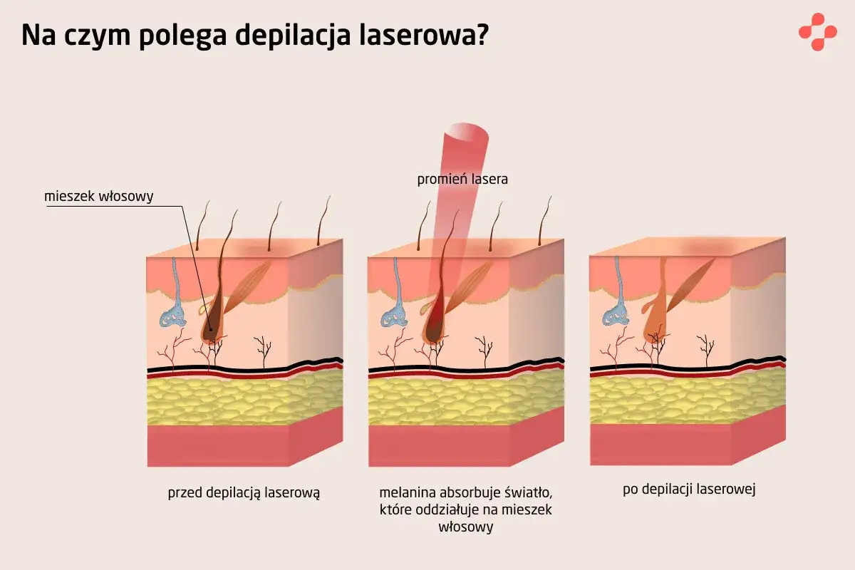 Ilustracja pokazuje, jak działa depilacja laserowa. Czy warto? Laser celuje w melaninę we włosie, niszcząc go.